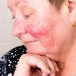 How to Manage and Treat Rosacea