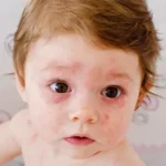 What Is Roseola?