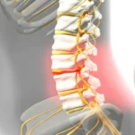 Herniated Disk: Symptoms and Diagnosis