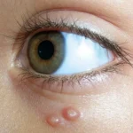 Molluscum Contagiosum