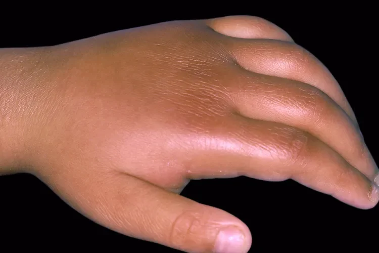 Kawasaki Disease: Symptoms and Treatment