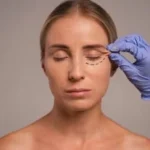 Understanding under eye laser treatment: What you need to know